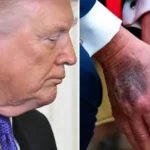 trumpin-derisinde-gizemli-kizariklik-once-eli-sonra-boynu-7pQcFrJd.webp